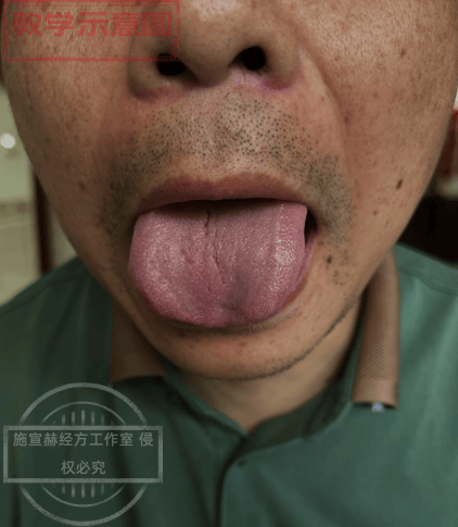 施门日记丨为什么别人的高血压能轻松控制？施老师给出中医答案