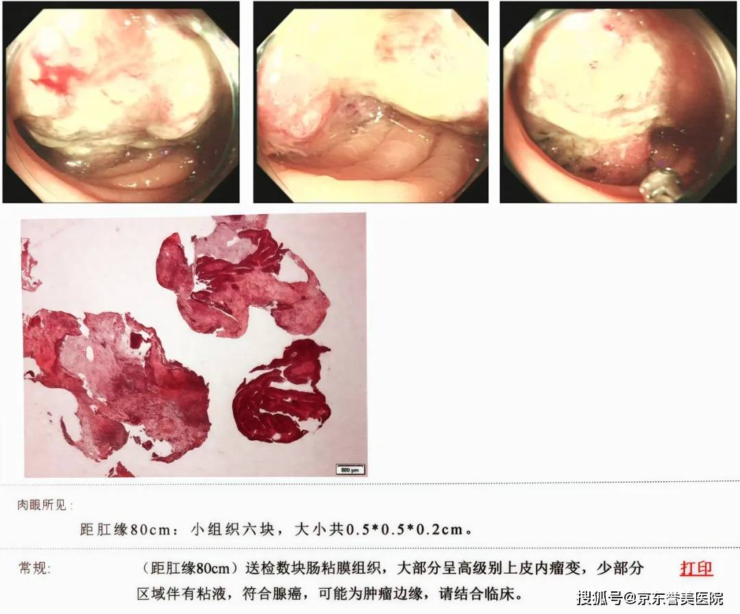 外卖小哥的肠镜报告：身体发出的「癌变预警」，你懂了吗？