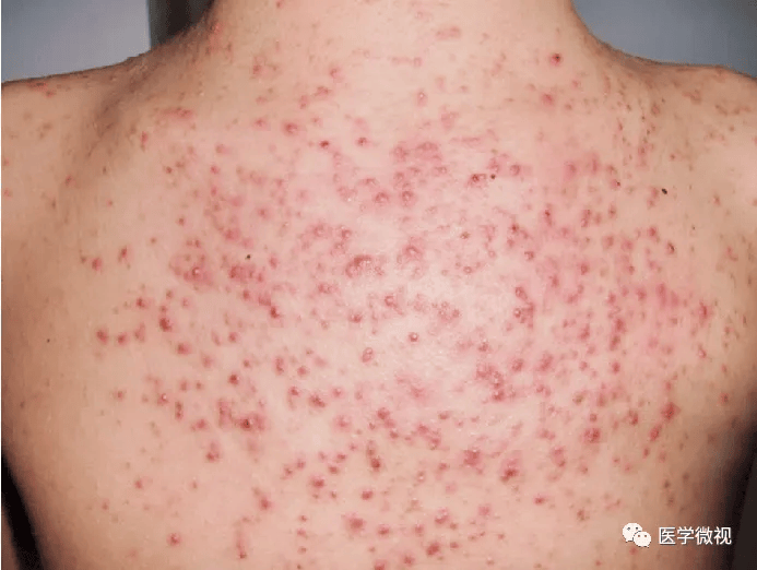 夏日，汗多季节的高发“常客”？皮肤科医生来揭秘