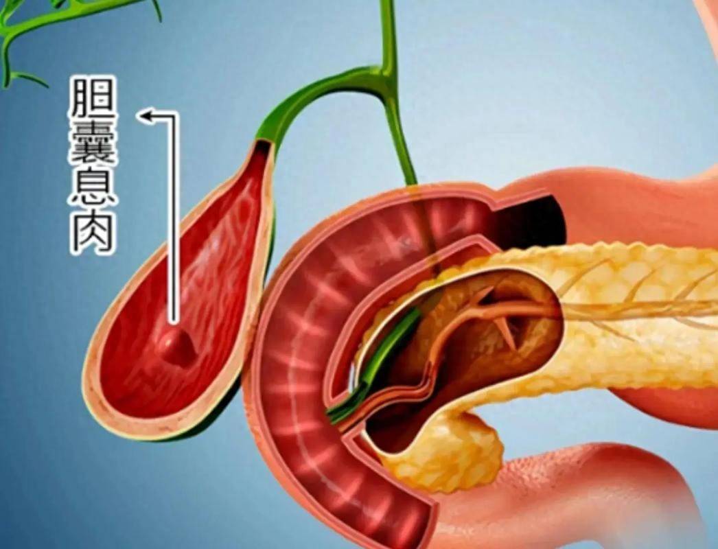 原创            体检发现胆囊息肉，别急着恐慌！95%是良性，但5类症状需就医