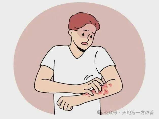 天疱疮-健脾祛湿方剂