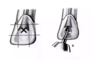 全口牙开髓如此到位，全靠这份详细位置图解！