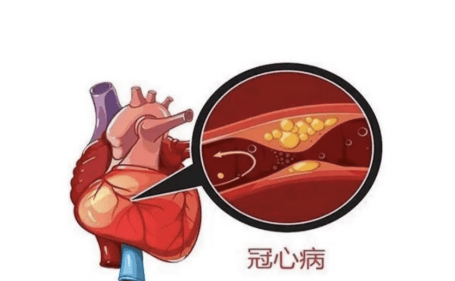 冠心病的中医调理