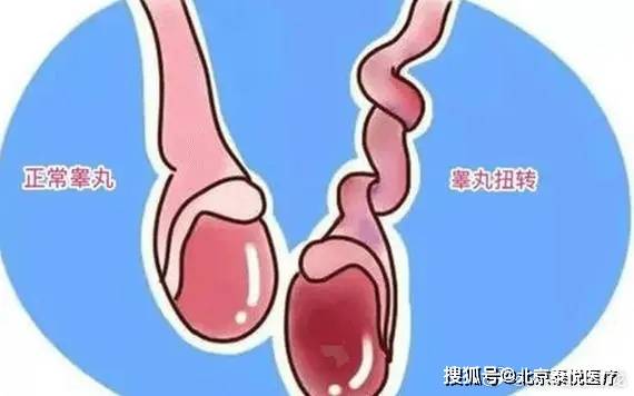 得了精索静脉曲张怎么办？莫惊慌，先来了解这些细节