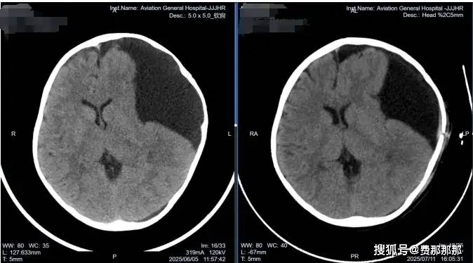 神外专家用软性神经内镜微创治愈助四岁患儿蛛网膜囊肿