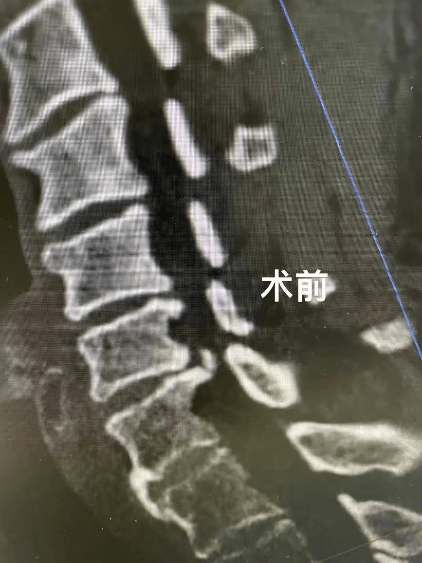 福州男子脚趾突然“失灵”！医生：病根在脖子！