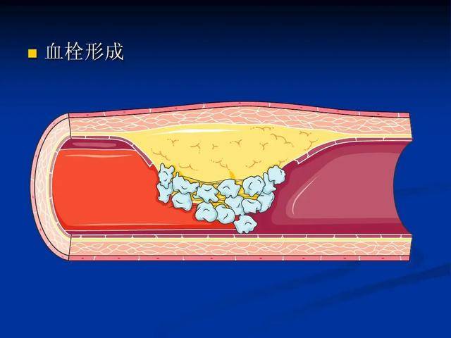 血栓不光堵心脑！不同部位出现的血栓，症状也各不同，一文总结