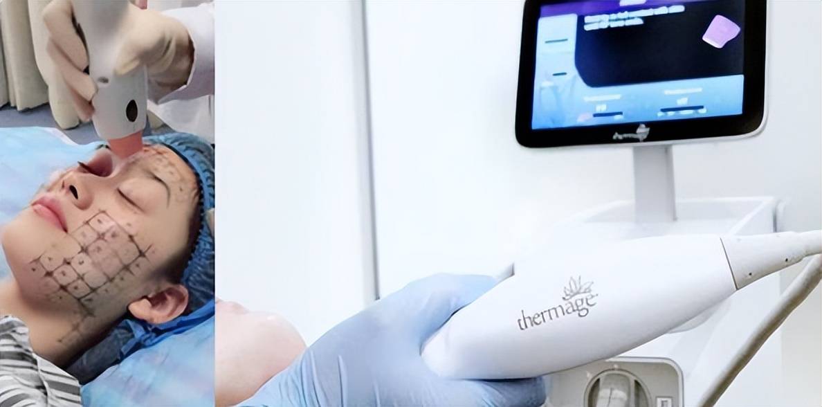 热玛吉是什么美容、50岁做热玛吉有效果吗、看完前后对比，沉默了！