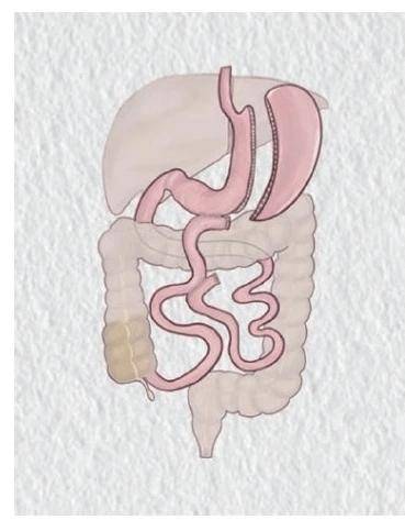 【朝医新闻】普外科团队完成单孔“袖状胃+双通道”减重手术