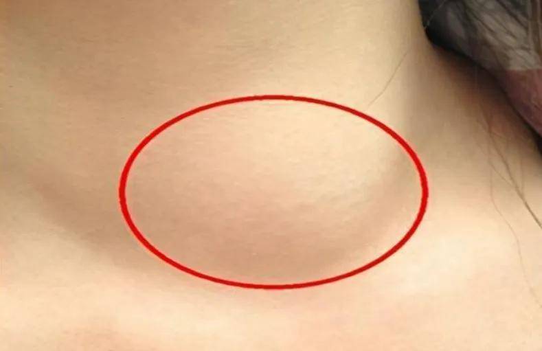 颈部淋巴结肿大，一定是甲状腺癌转移来的吗？