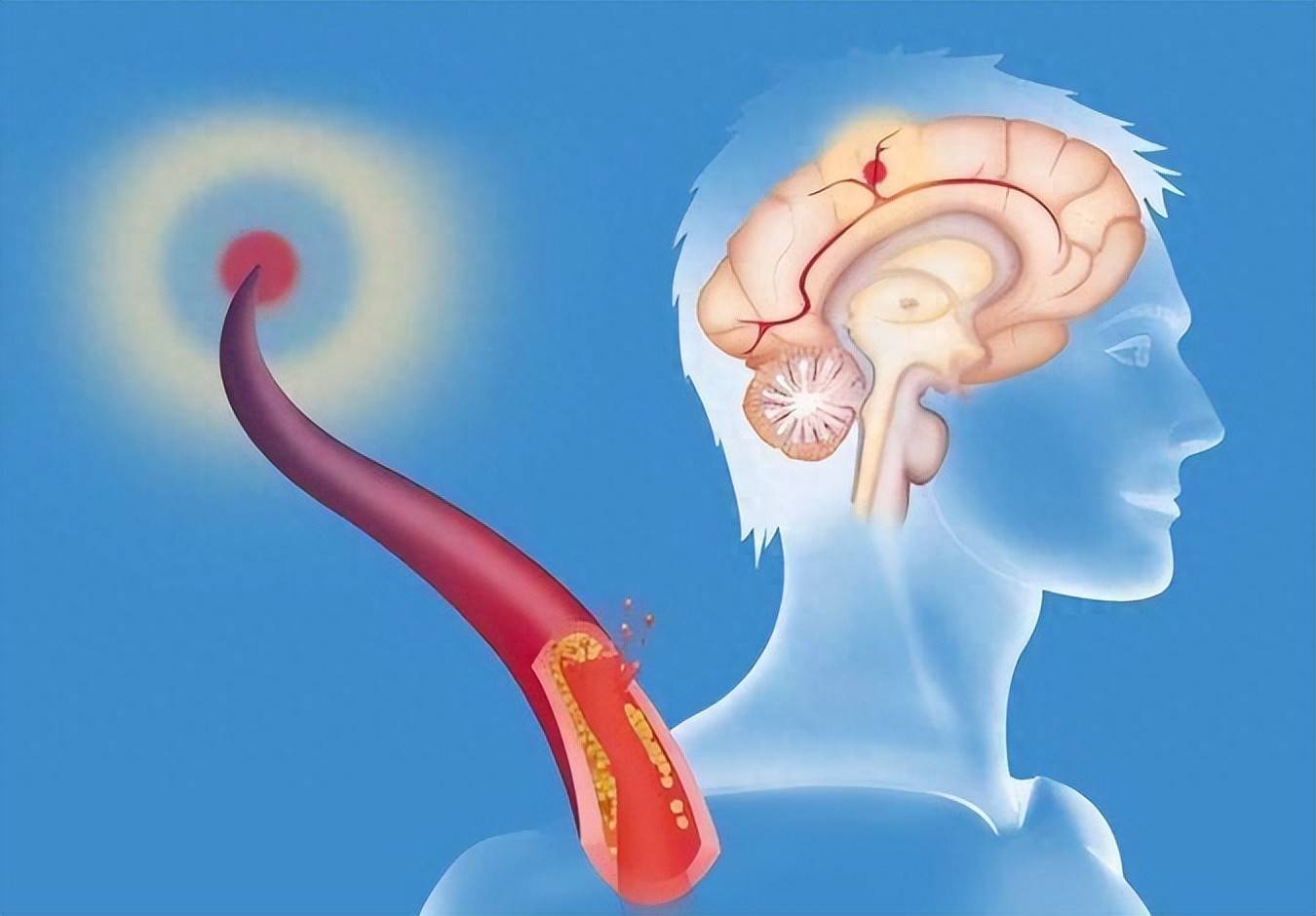 原创            脑栓塞几秒钟让你偏瘫、失语，甚至猝死？这些突发信号别忽视