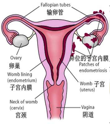 子宫内膜异位症：了解症状、诊断与治疗