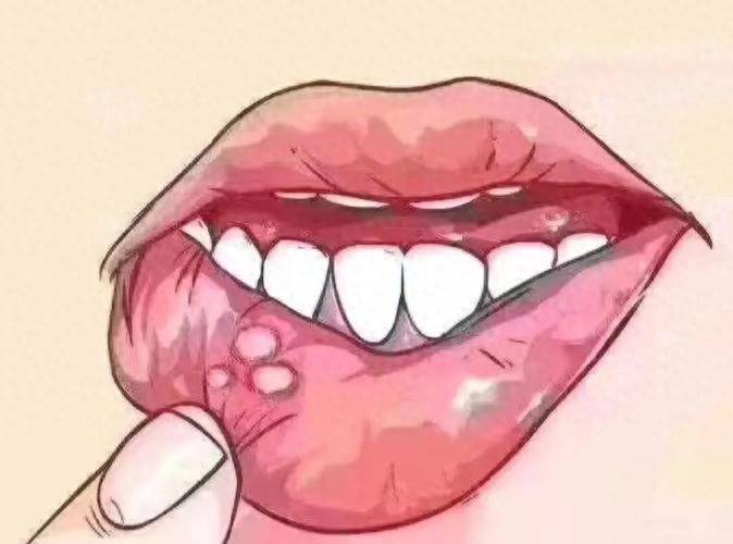 原创            口腔溃疡总不好？这6招自救指南，让你告别反复发作