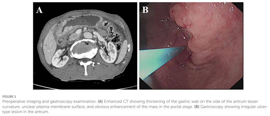 PD-L1阳性/MSI-H胃窦腺鳞癌获益免疫联合化疗，取得长期缓解