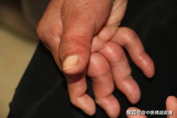 年轻无畏？风湿性关节炎悄然来袭，这些早期信号别忽视！