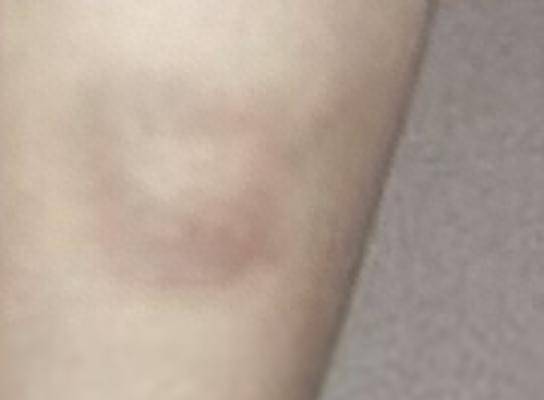 孩子频繁流鼻血，只是“上火”？腿上症状引医生警惕，精准识破“止血胶水”缺失病