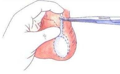 缓解男人结扎后疼痛，这4个方法超有效