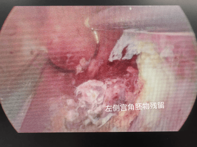 健康科普丨宫腔镜：妇科医生的放大镜