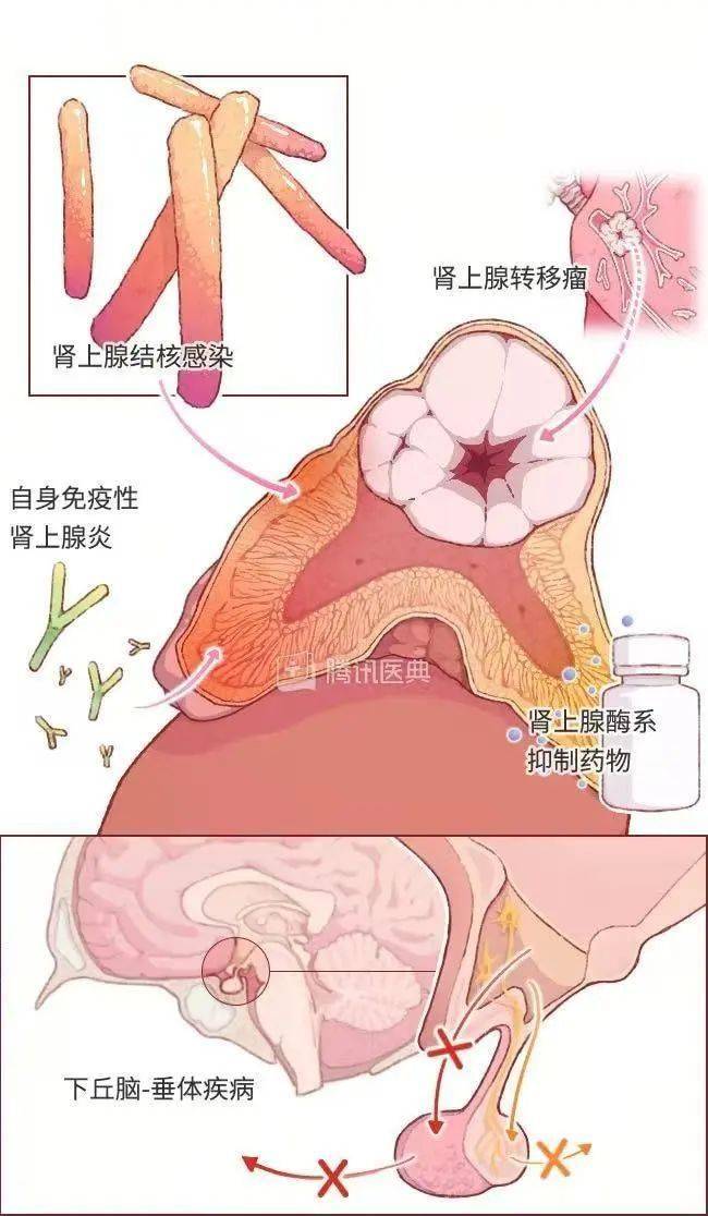 孩子皮肤黑，不是晒的，竟然是这个病......