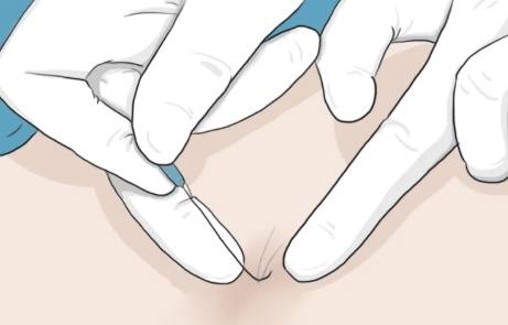 当健康遇上减重，埋线减肥带你解锁“轻” 松密码！