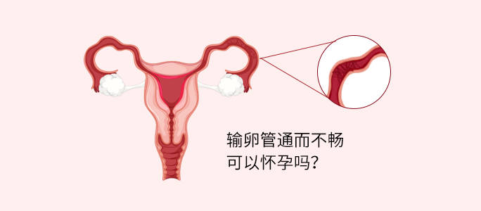 祝秀英医生：什么是输卵管通而不畅？导致输卵管通而不畅的原因有哪些？