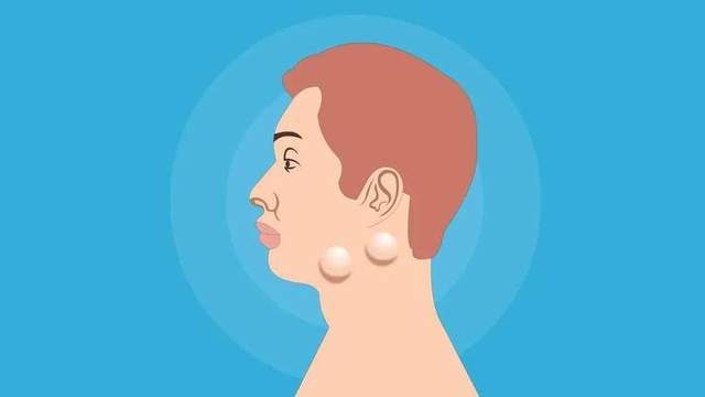 原创            淋巴结肿大？别紧张！90%是良性的，但出现这些症状，需就医筛查