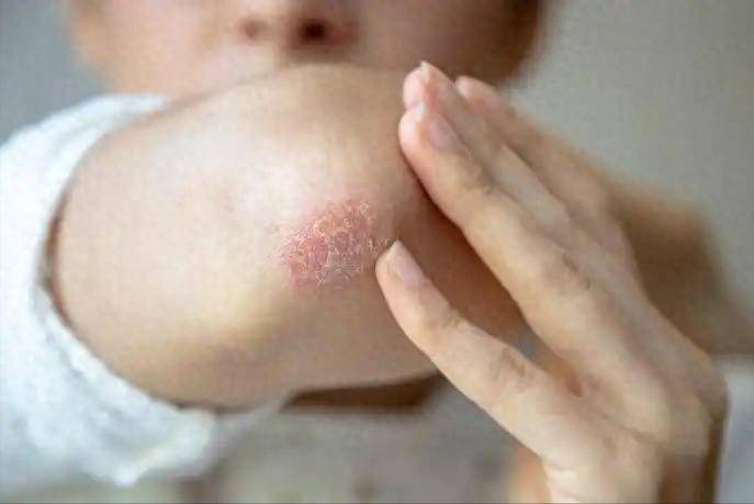 医生提醒：最能加重湿疹的行为，不是吃辣！而是经常去做4件事