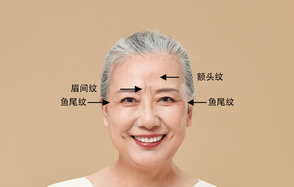 杭州市一医学美容中心中、重度眉间纹受试者招募