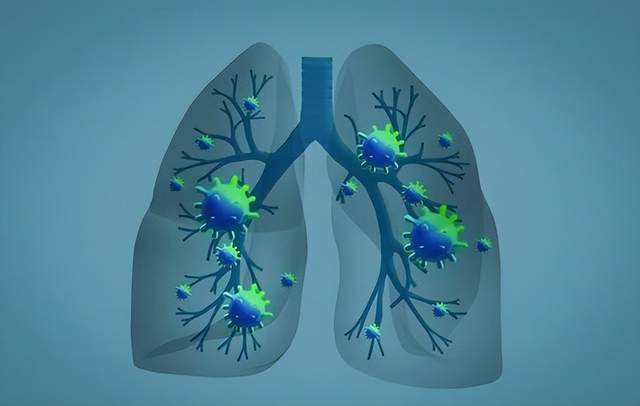 原创            5类人群预防肺结节，医生提示：识别好坏，注意这5个特征