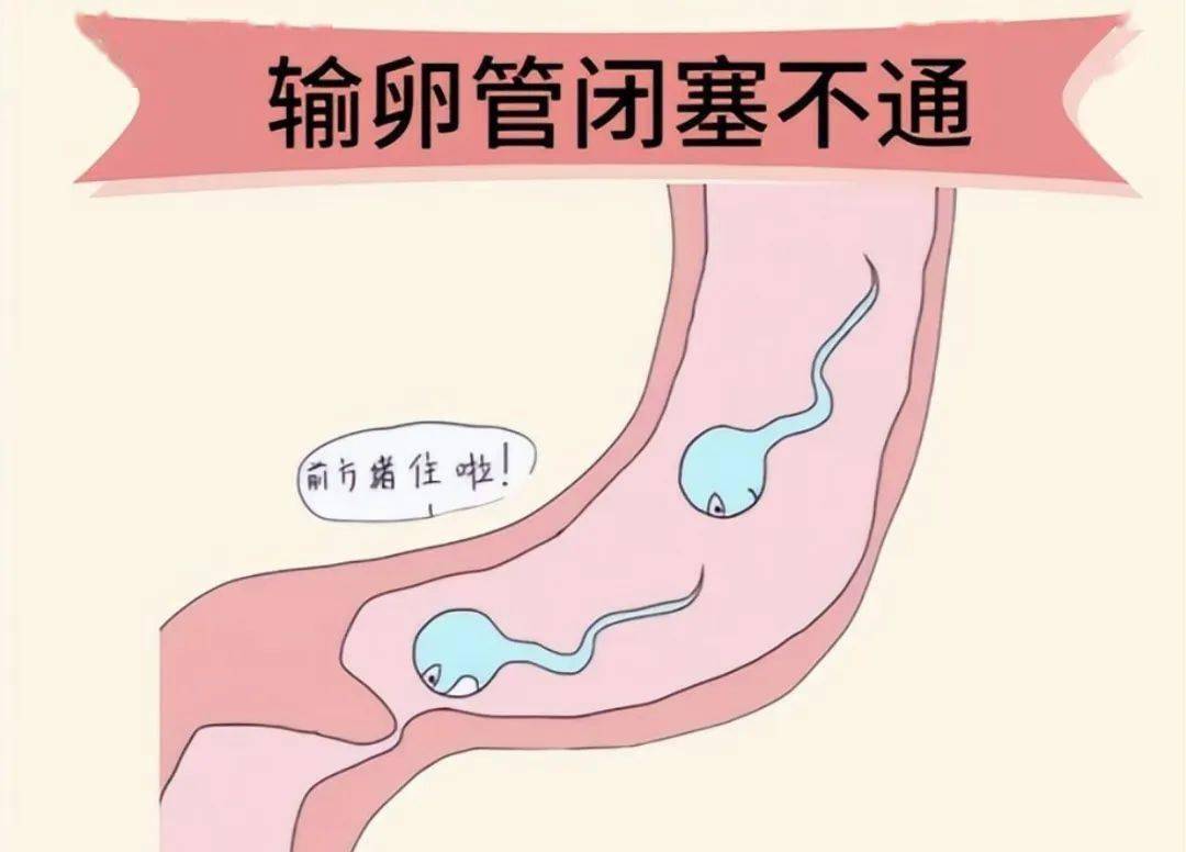 输卵管闭塞不通或缺失怎么办？