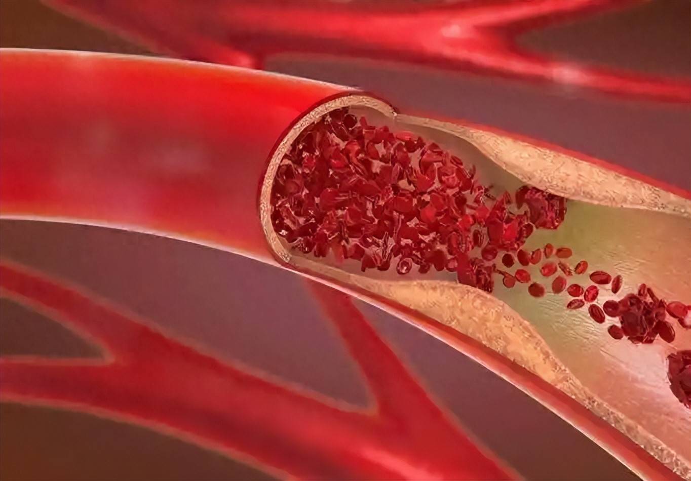 原创            50%静脉血栓无症状，直到肺栓塞发作才发现，4类人群做好预防