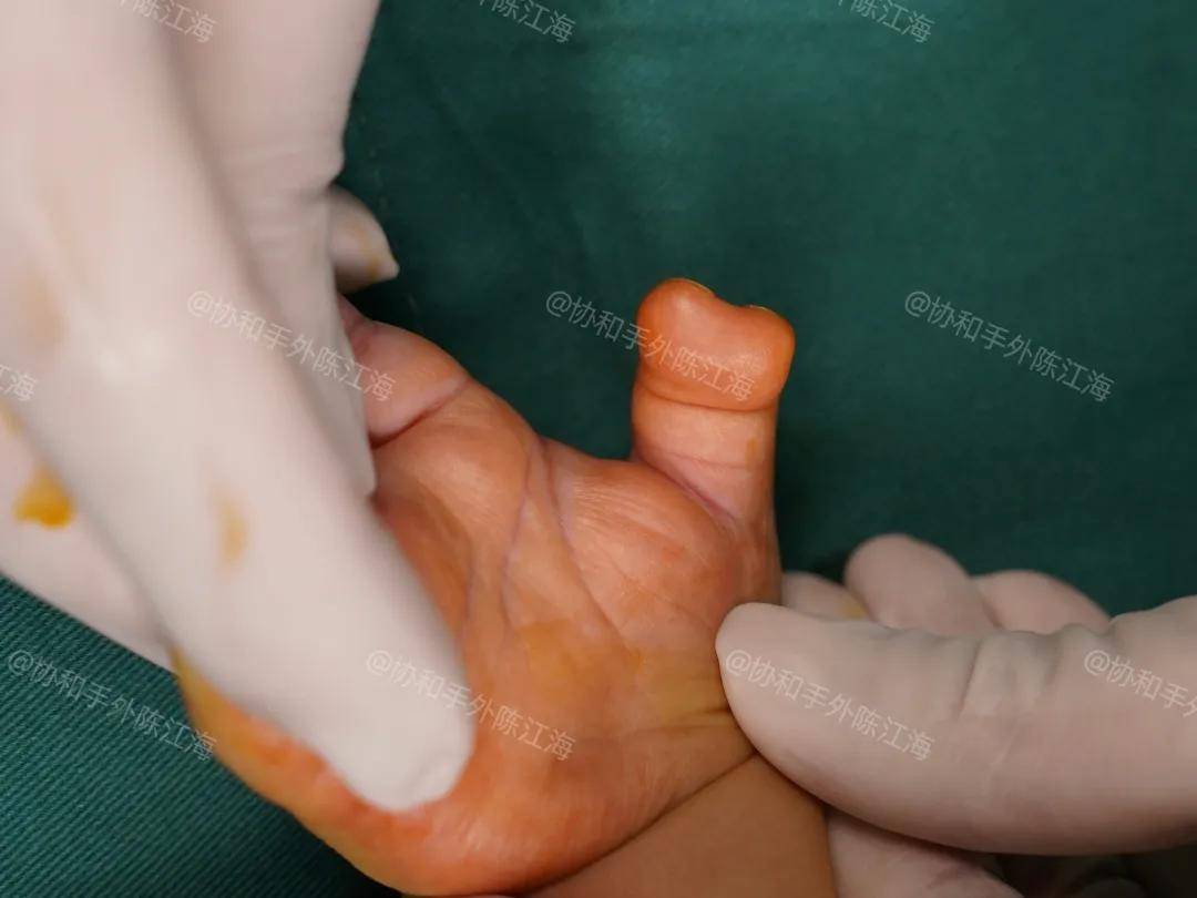 原创            多指│案例45《女宝多指术后5个月：太神奇了，很感动！》