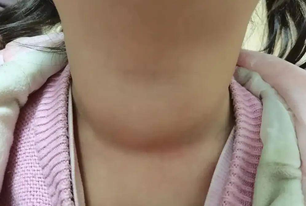 脖子变粗、眼睛突出？警惕这种 “伪装” 成眼病的甲状腺问题！