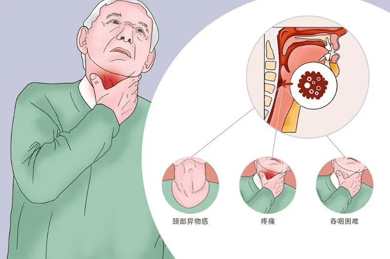 这种“上火”竟然是癌？！专家一摸脖，就紧皱眉头
