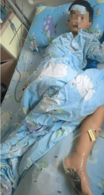 6岁男童沙滩光脚踩到死鱼，次日高烧进ICU！医生提醒：死亡率极高