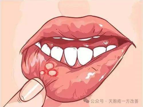 十日祛湿见奇效：中医辨治天疱疮有妙方