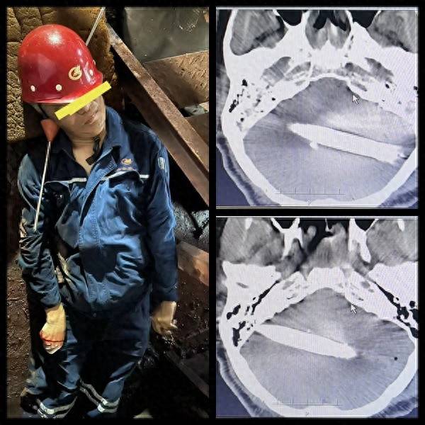 钢筋贯穿颅脑奇迹生还！医生双侧开颅取出钢筋，一个多月后患者康复出院