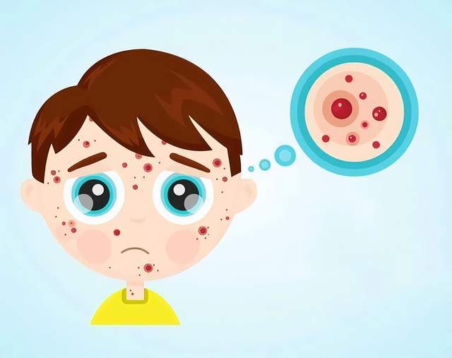 原创            又到开学季，水痘高发期！孩子返校出现这些症状，家长要注意