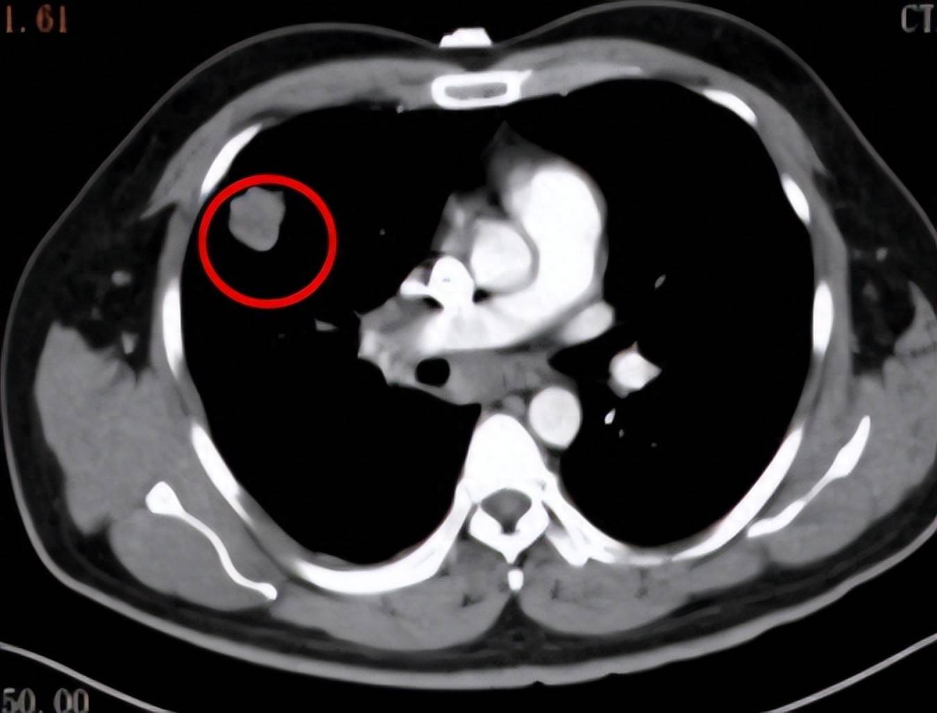从无法手术到成功切除！新辅助治疗为晚期肺癌患者带来生机