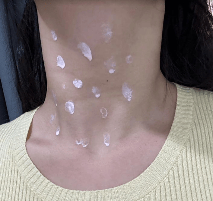 除疣选对法，坚持换光滑肌肤