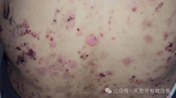 告别反复发作！中医健脾祛湿方，让天疱疮患者恢复健康皮肤！