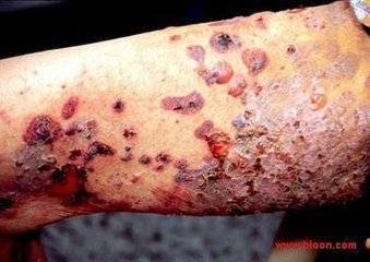 疱疮缠身苦不堪言，老中医一方健脾祛湿，烂皮回春！