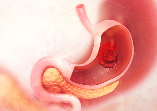 韩照予主任：三大伤胃习惯，正在悄悄靠近胃癌