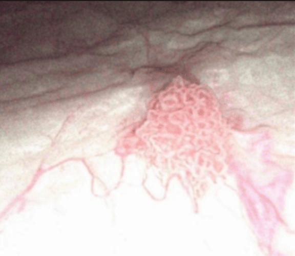 【“医”说就懂】出现这种颜色的尿要当心，可能是癌症前兆！