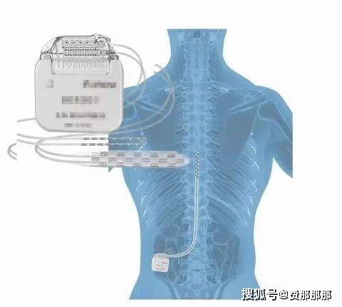 脊髓电刺激术可以治疗哪些疾病？