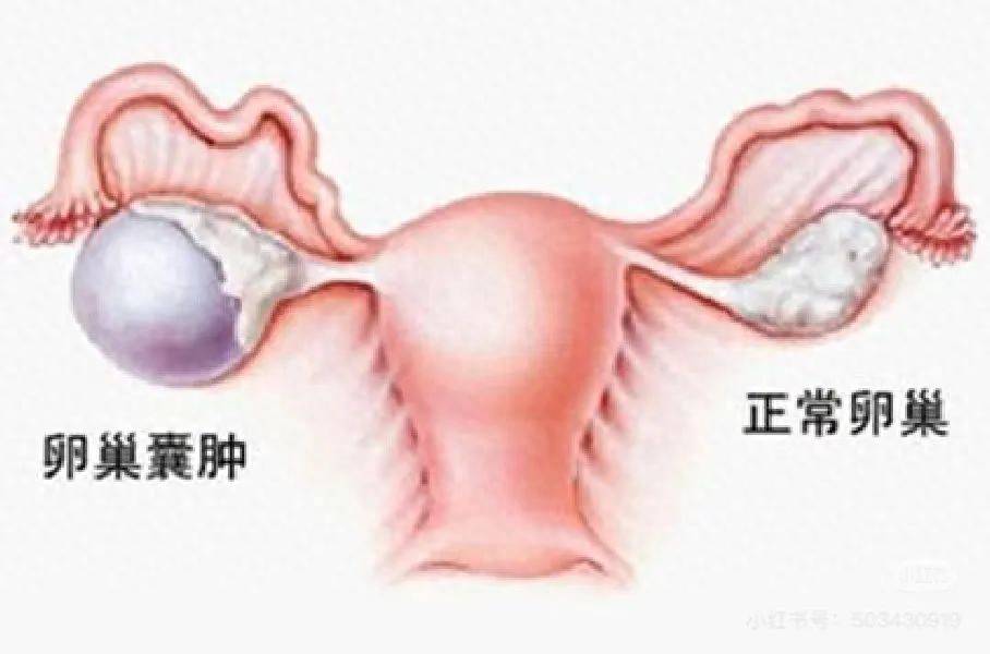 绝经后卵巢肿物竟藏“妇癌之王”风险 医生提醒及时行动
