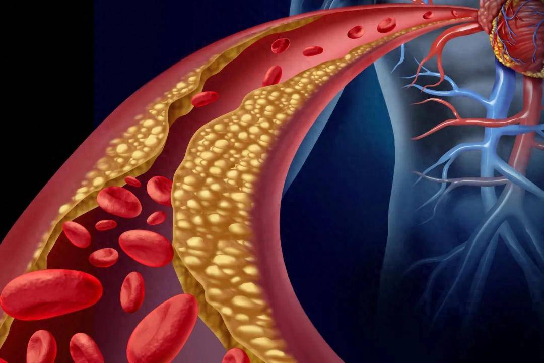 甘油三酯从5.1降到1.7，只需做好这4点！建议收藏