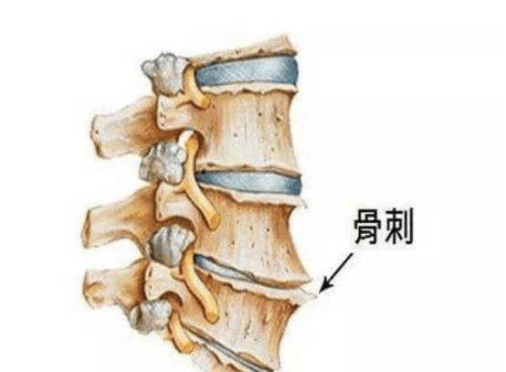 骨质增生终于舒服了！分享真实有效的康复经验，少走弯路！