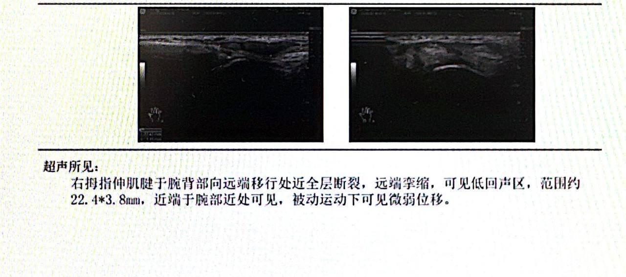 小伙拆了个快递后，大拇指竟伸不直了！医生提醒，这些行为很危险