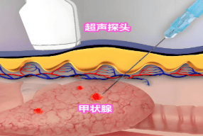 科普 | 甲状腺穿刺活检：揭开神秘面纱，科学应对不必慌